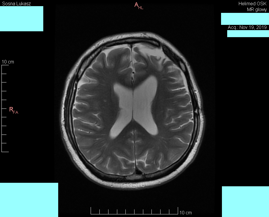 Wynik rezonansu magnetycznego głowy - Łukasz Sosna - rok 2019 - zdjęcie 1