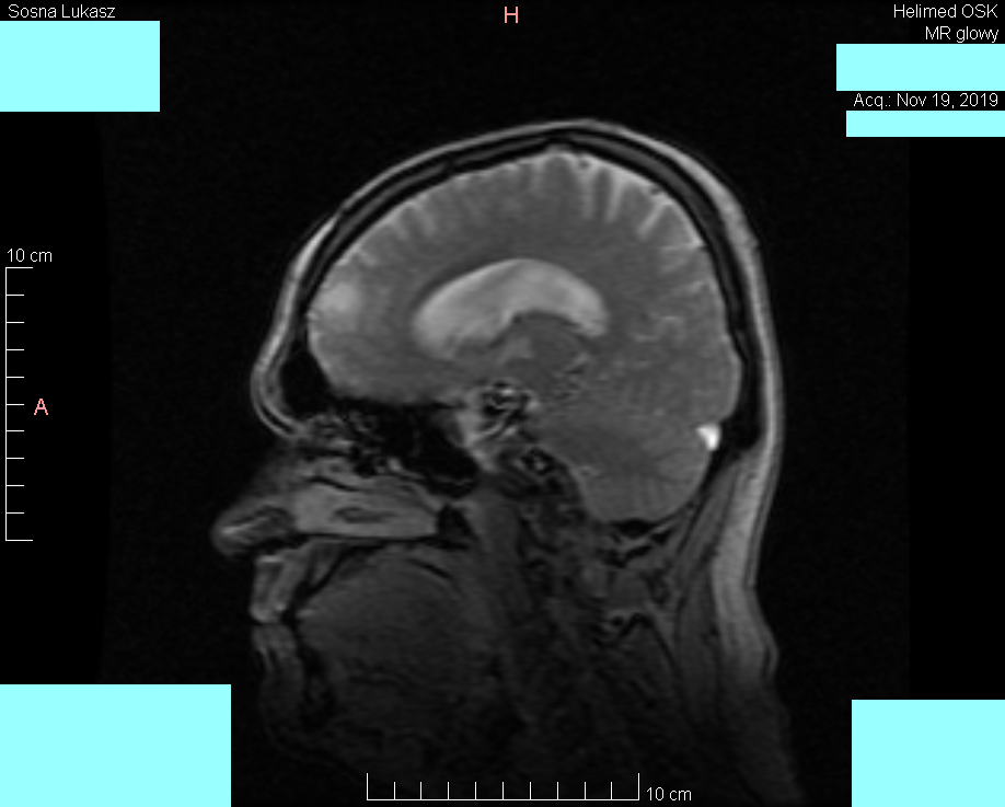 Wynik rezonansu magnetycznego głowy - Łukasz Sosna - rok 2019 - zdjęcie 3
