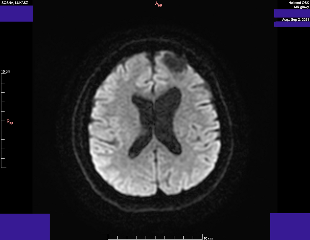 Wynik rezonansu magnetycznego głowy - Łukasz Sosna - rok 2021 - zdjęcie 3