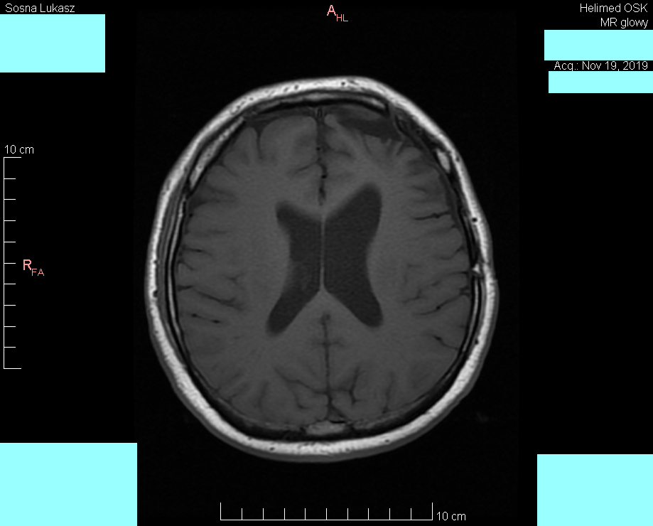Wynik rezonansu magnetycznego głowy - Łukasz Sosna - rok 2019 - zdjęcie 4