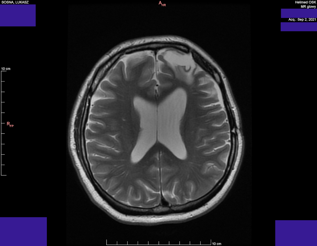 Wynik rezonansu magnetycznego głowy - Łukasz Sosna - rok 2021 - zdjęcie 4