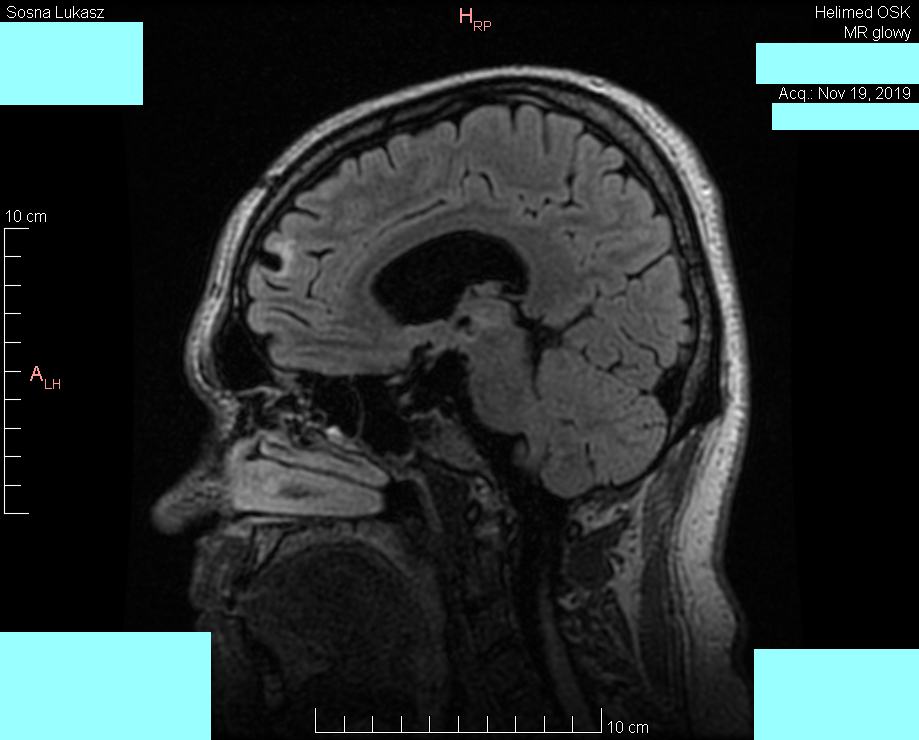 Wynik rezonansu magnetycznego głowy - Łukasz Sosna - rok 2019 - zdjęcie 6