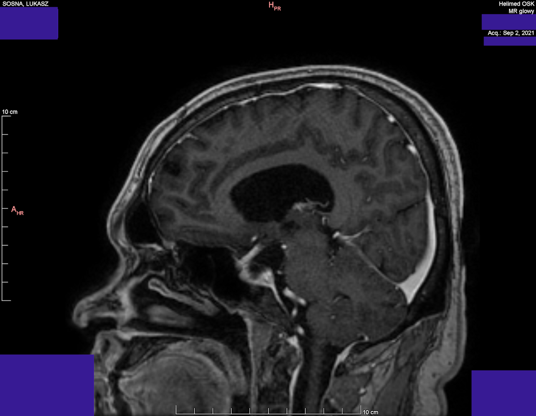 Wynik rezonansu magnetycznego głowy - Łukasz Sosna - rok 2021 - zdjęcie 7