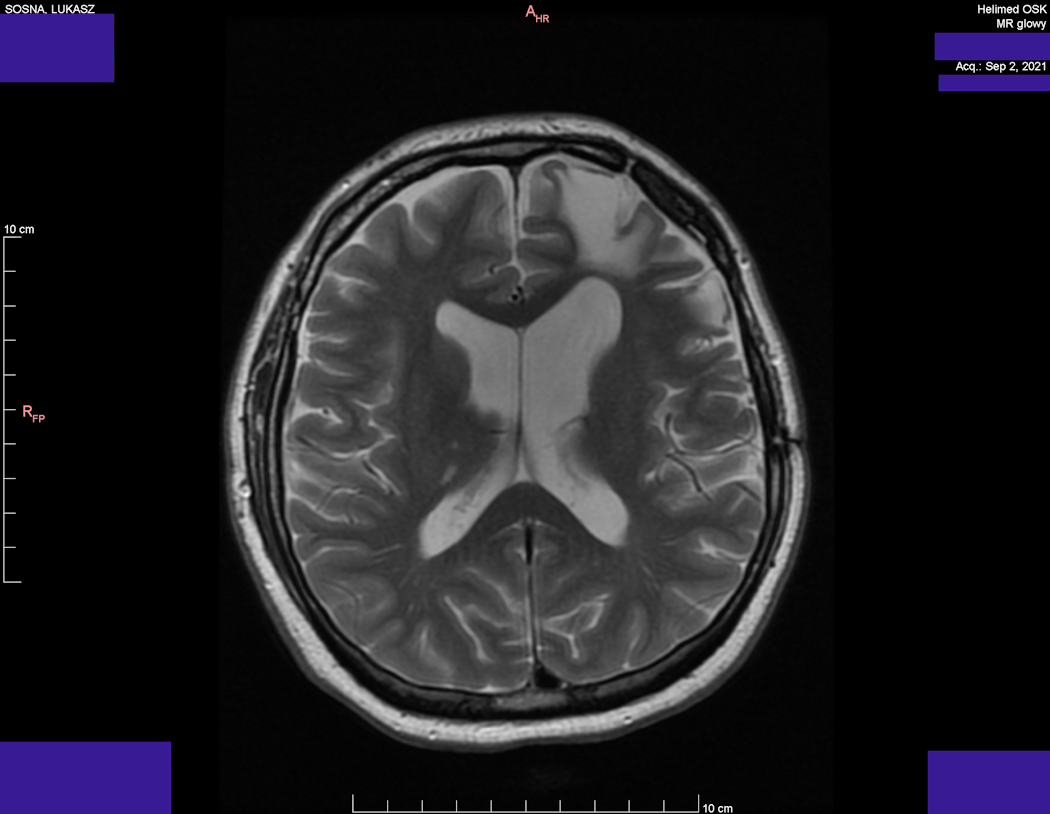 Wynik rezonansu magnetycznego głowy - Łukasz Sosna - rok 2021 - zdjęcie 1