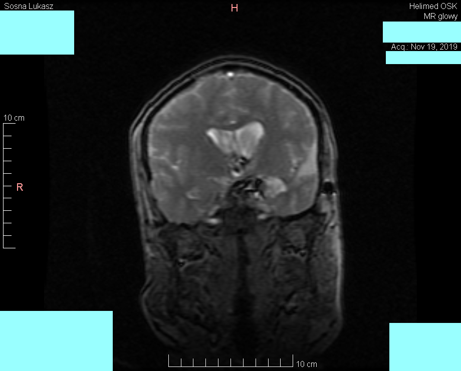 Wynik rezonansu magnetycznego głowy - Łukasz Sosna - rok 2019 - zdjęcie 2