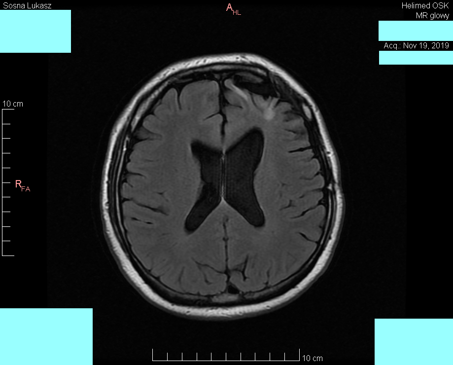 Wynik rezonansu magnetycznego głowy - Łukasz Sosna - rok 2019 - zdjęcie 5