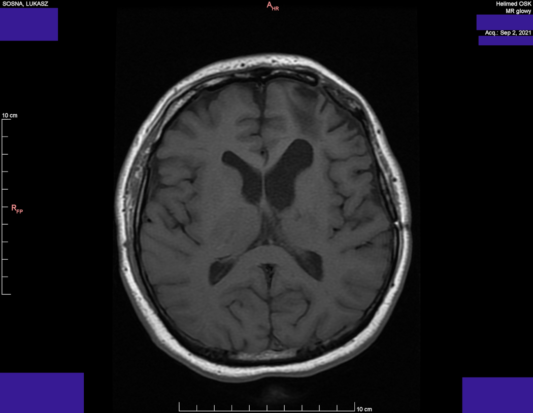 Wynik rezonansu magnetycznego głowy - Łukasz Sosna - rok 2021 - zdjęcie 5