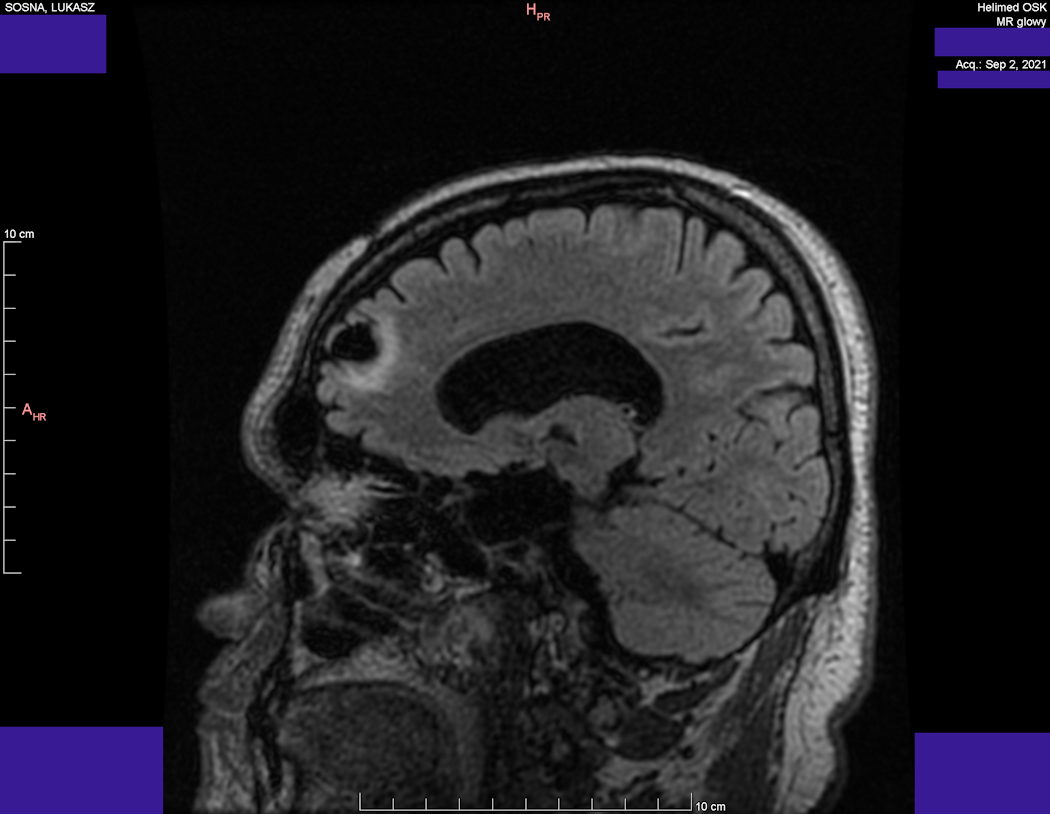 Wynik rezonansu magnetycznego głowy - Łukasz Sosna - rok 2021 - zdjęcie 6