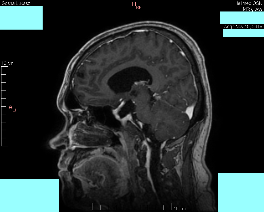 Wynik rezonansu magnetycznego głowy - Łukasz Sosna - rok 2019 - zdjęcie 8