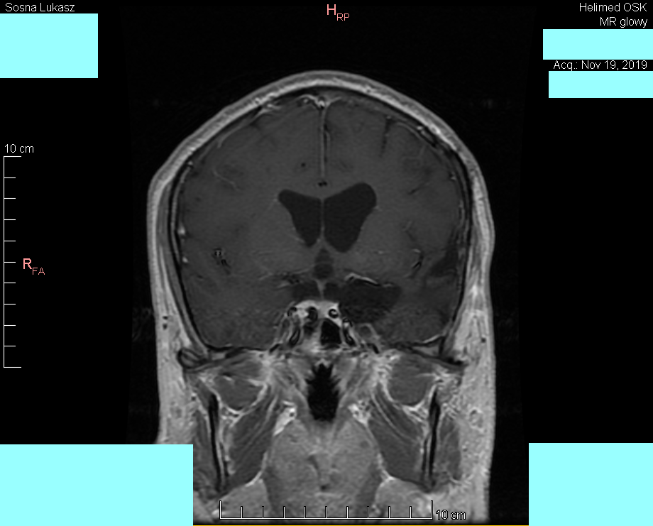 Wynik rezonansu magnetycznego głowy - Łukasz Sosna - rok 2019 - zdjęcie 9